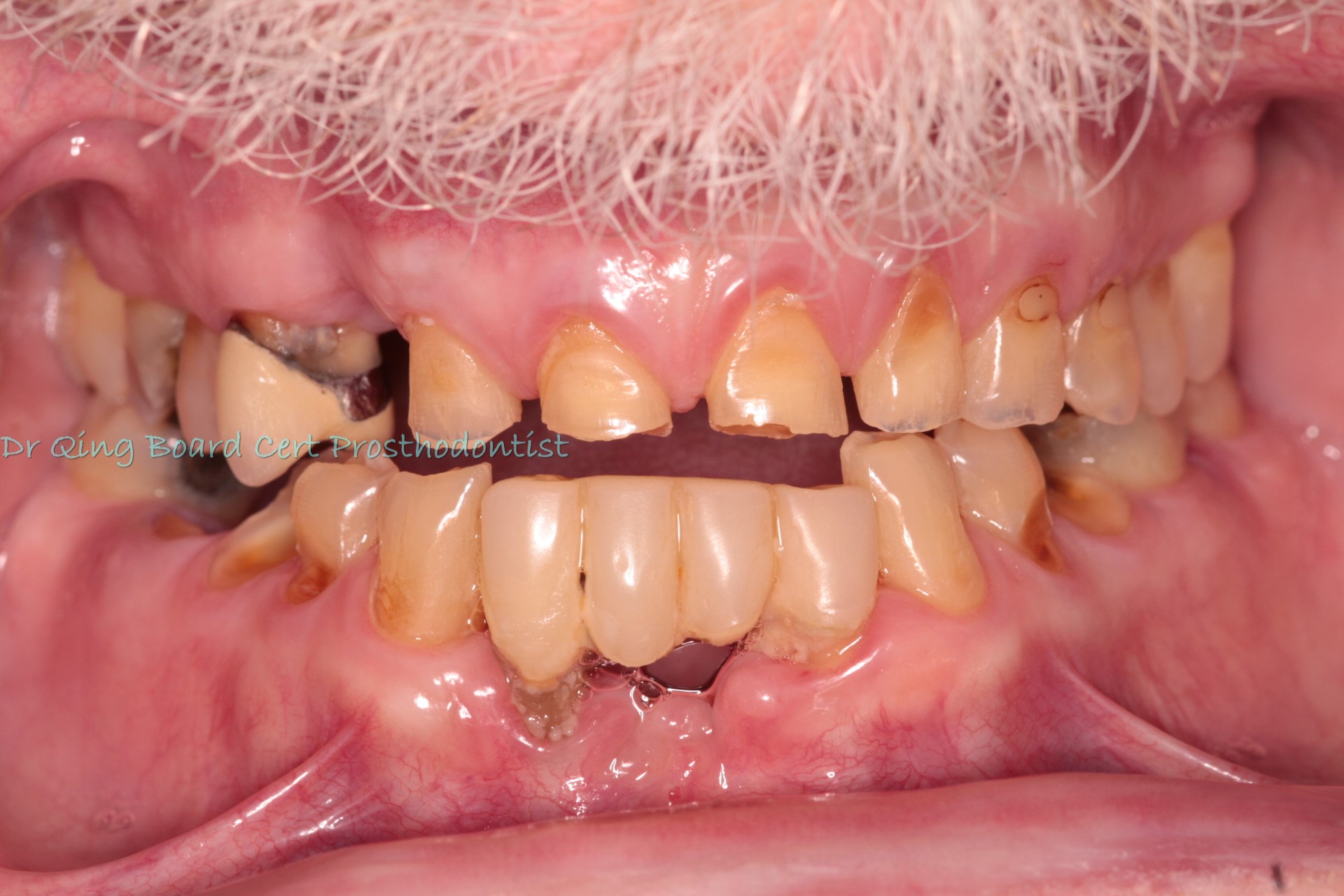 Full-mouth restorations