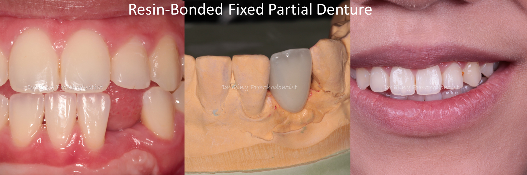 Resin-bonded Fixed Partial Denture