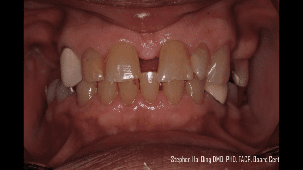 Esthetic Removable Partial Denture patient