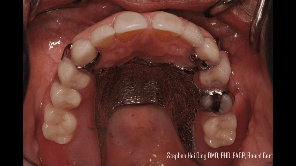 Esthetic Removable Partial Denture patient