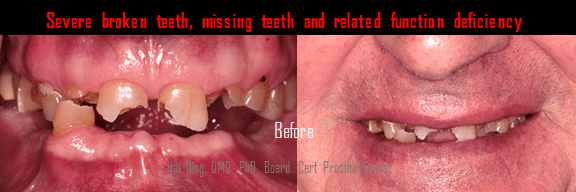 Dental Bridge patient