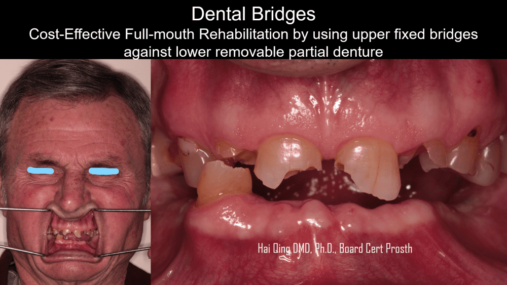 Dental Bridge patient