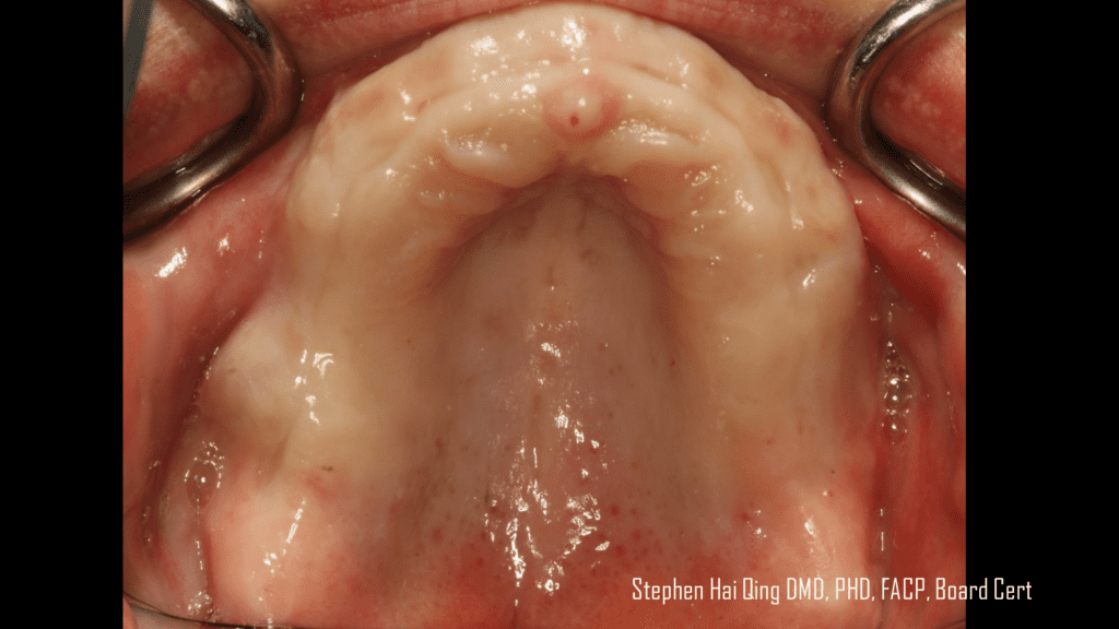 Implant-supported crown and bridge prosthesis  patient