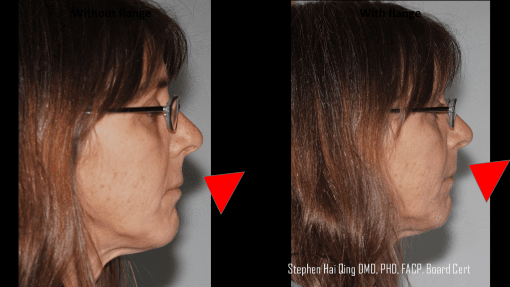 Implant-supported crown and bridge prosthesis  patient