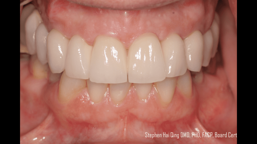 Implant-supported crown and bridge prosthesis  patient