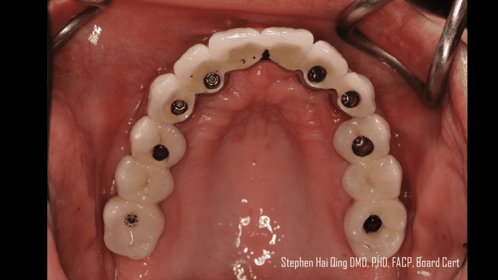Implant-supported crown and bridge prosthesis  patient