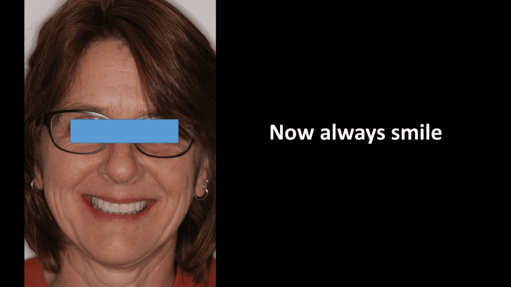 Implant-supported crown and bridge prosthesis  patient