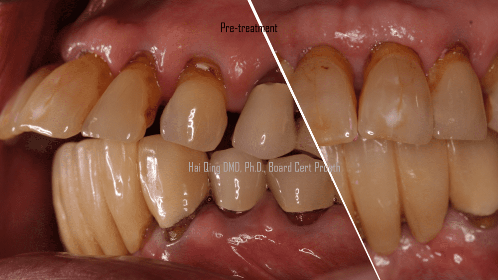 Implant Supported Fixed Denture  patient