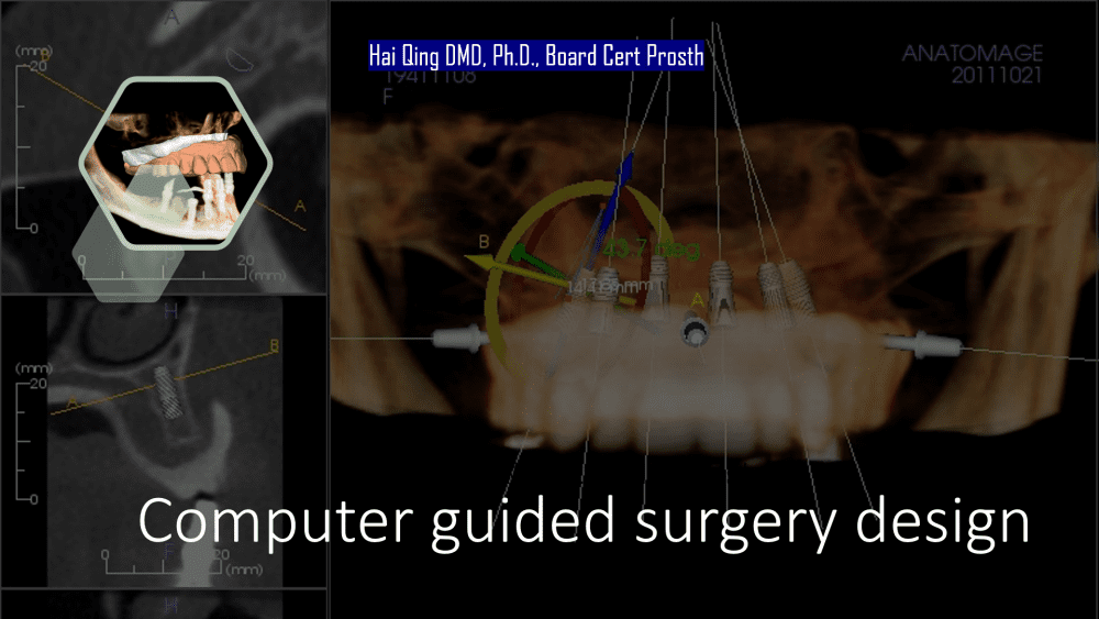 Implant Supported Fixed Denture  patient