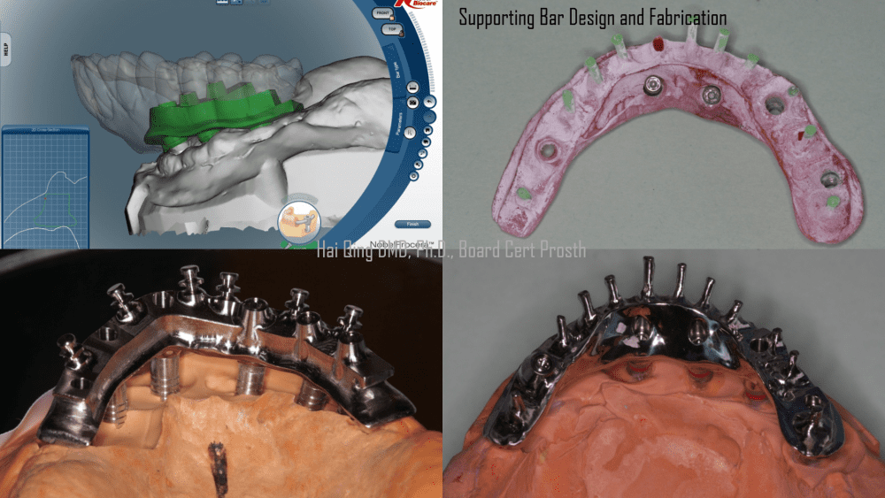 Implant Supported Fixed Denture  patient