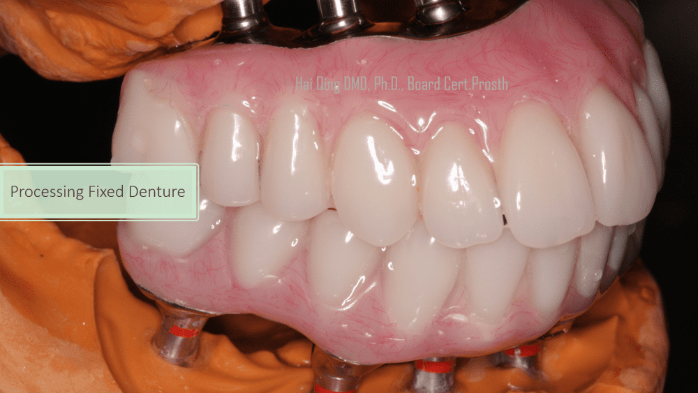 Implant Supported Fixed Denture  patient