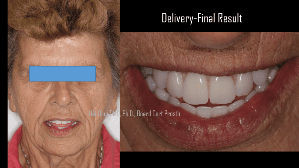 Implant Supported Fixed Denture  patient