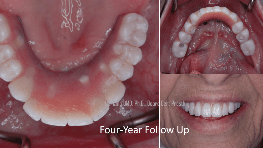 Implant Supported Fixed Denture  patient