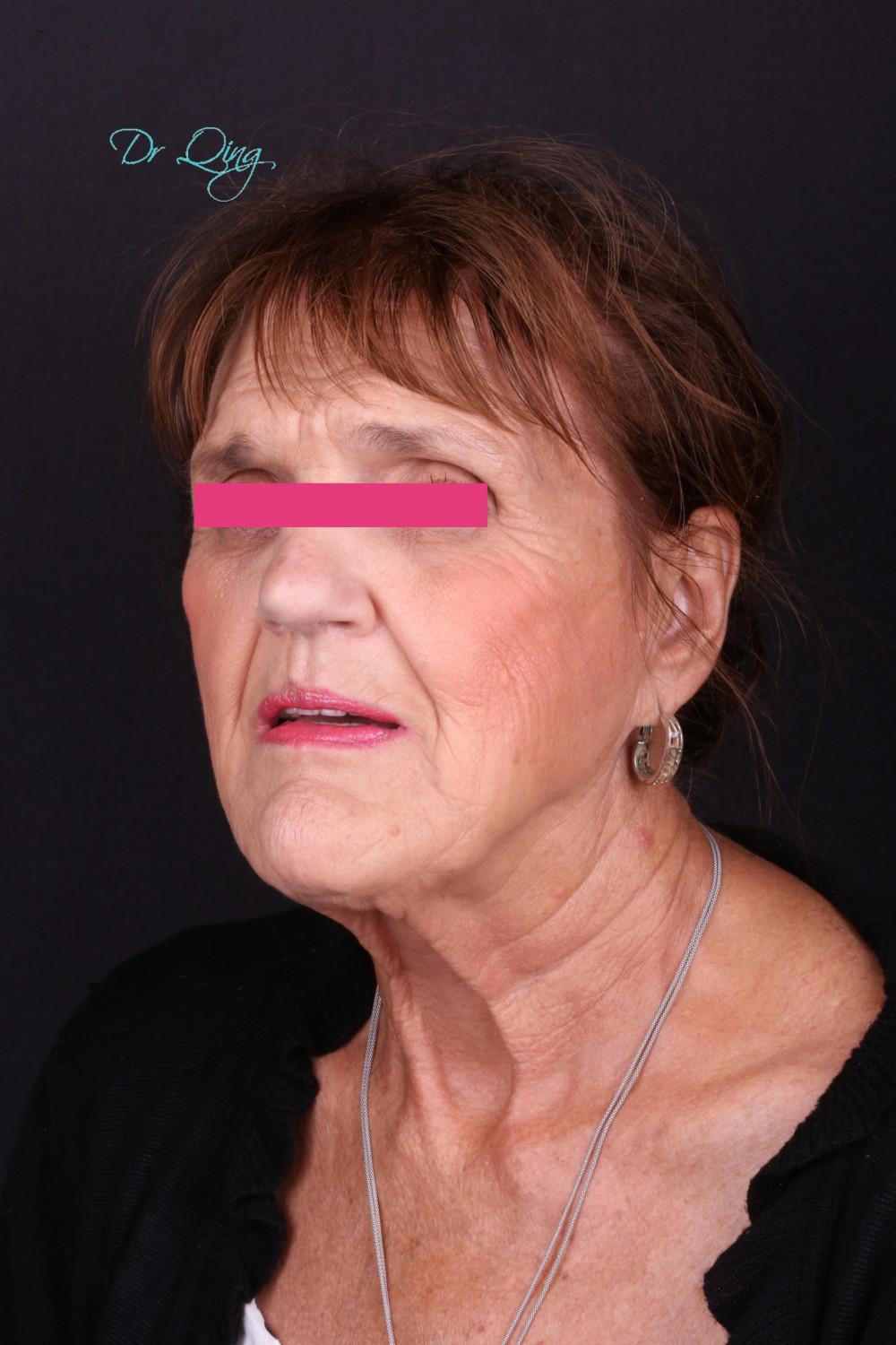 Dental Bridge patient