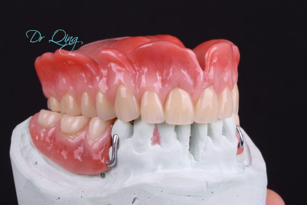Dental Bridge patient
