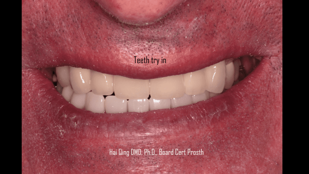 Dental Bridge patient
