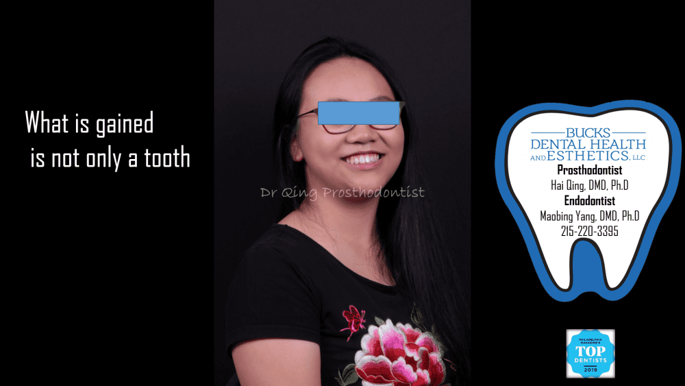 Resin-bonded Fixed Partial Denture patient