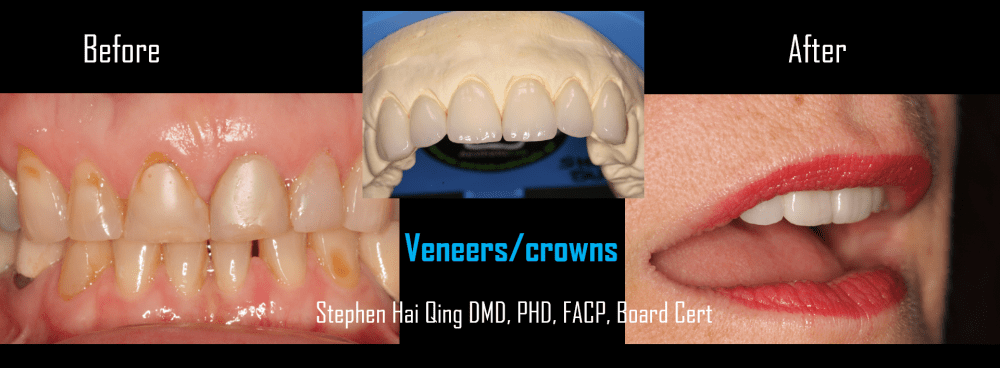 Cosmetic Ceramic Veneers patient