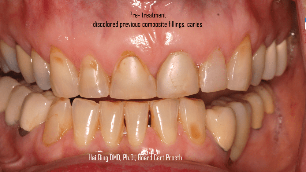 Cosmetic Ceramic Veneers patient