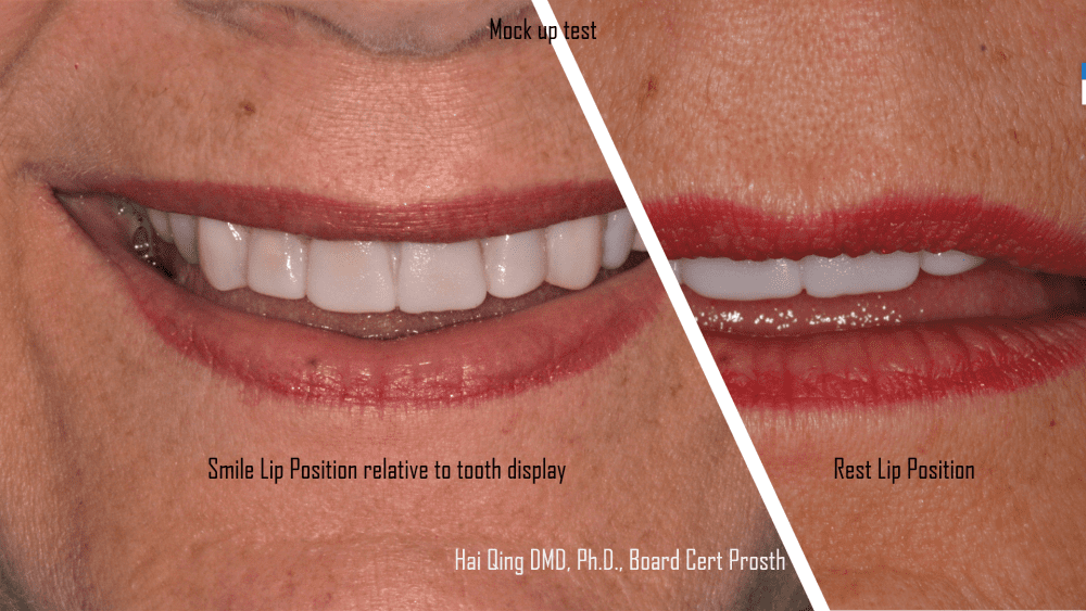 Cosmetic Ceramic Veneers patient