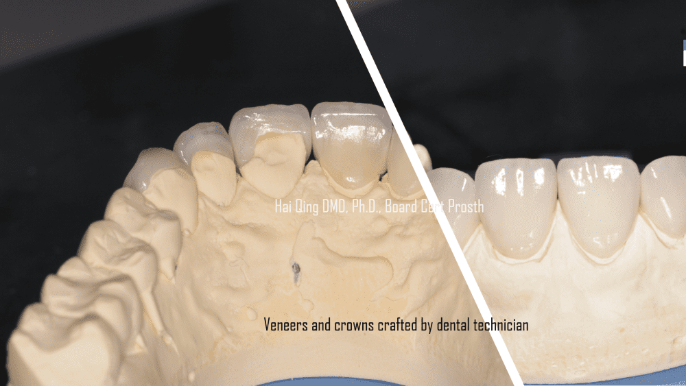 Cosmetic Ceramic Veneers patient