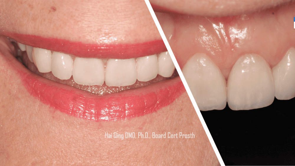 Cosmetic Ceramic Veneers patient