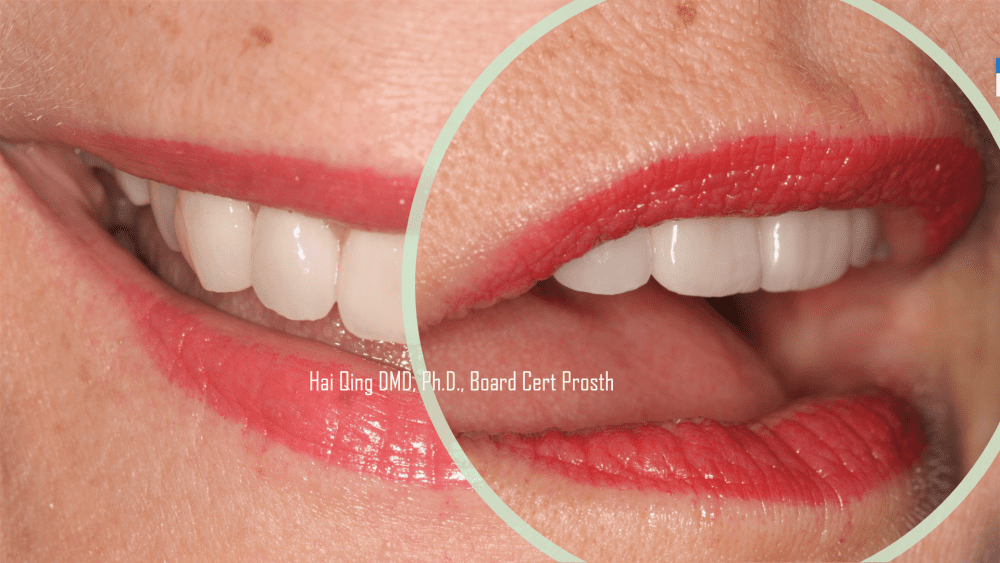 Cosmetic Ceramic Veneers patient