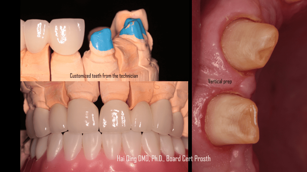 Dental Bridge patient