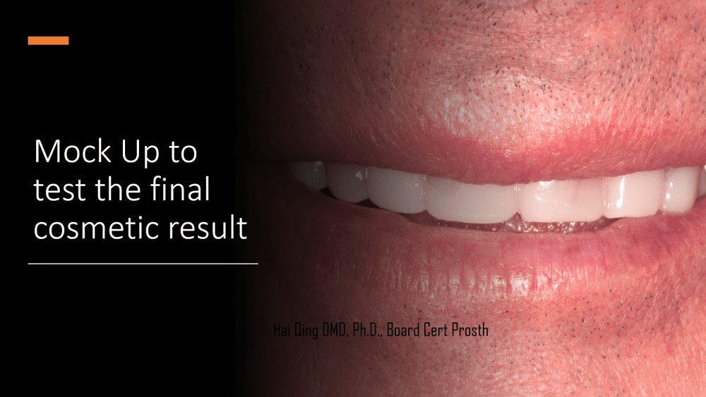 Dental Bridge patient