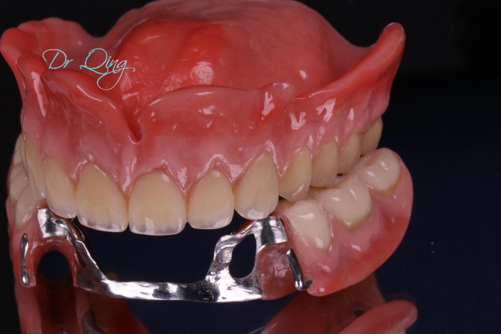 Dental Bridge patient