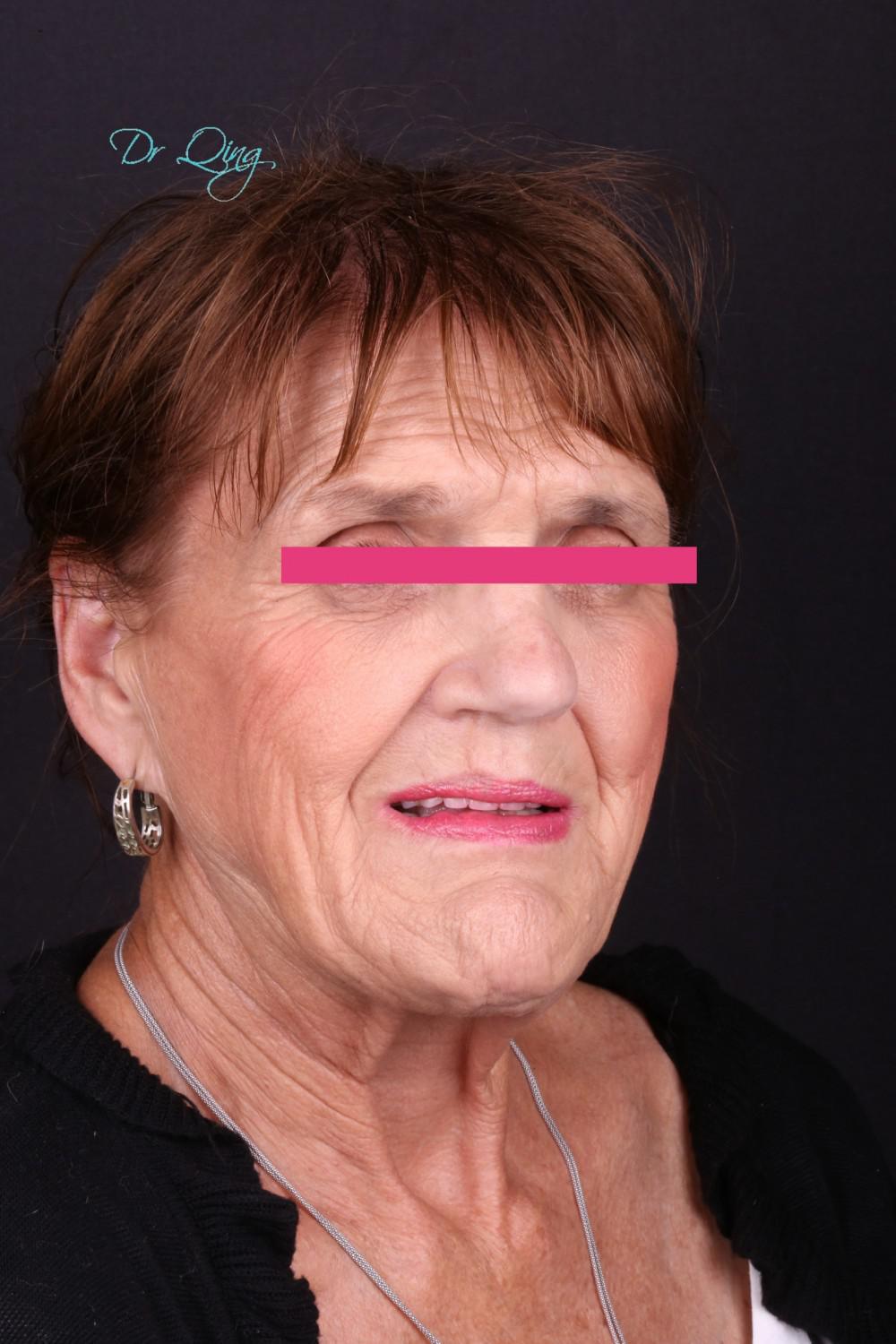 Dental Bridge patient